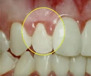 Link to more info about Gum Disease Treatment