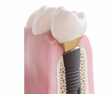 Choosing a Professional for Your Dental Implants in Shreveport