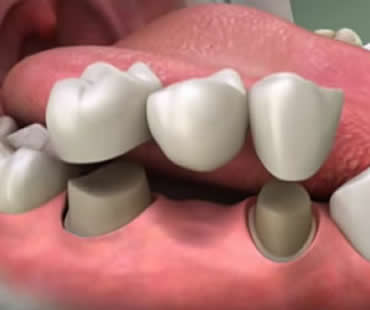 How to Make Your Dental Crowns and Bridges Last
